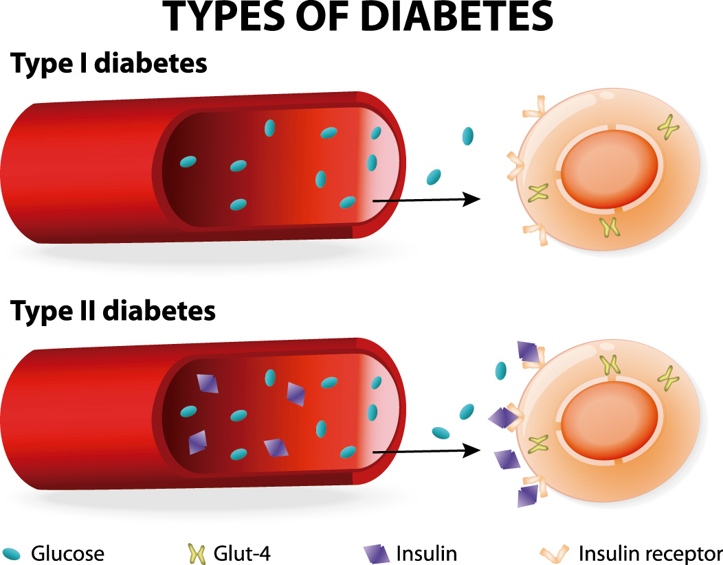 Eliminar diabetes tipo 2